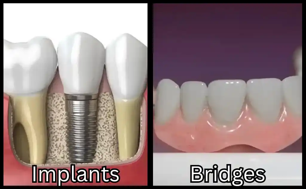 Implants Versus Bridges